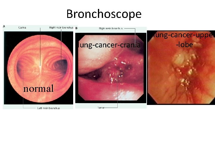 Bronchoscope lung-cancer-crania normal lung-cancer-upper -lobe 