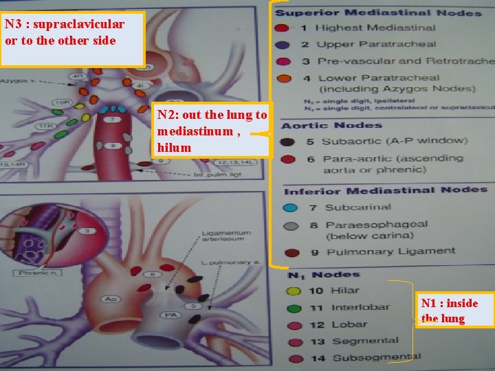 N 3 : supraclavicular or to the other side N 2: out the lung N 3 : supraclavicular or to the other side N 2: out the lung