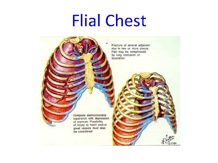 Flial Chest 