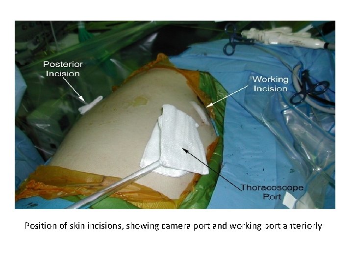 Position of skin incisions, showing camera port and working port anteriorly Position of skin incisions, showing camera port and working port anteriorly