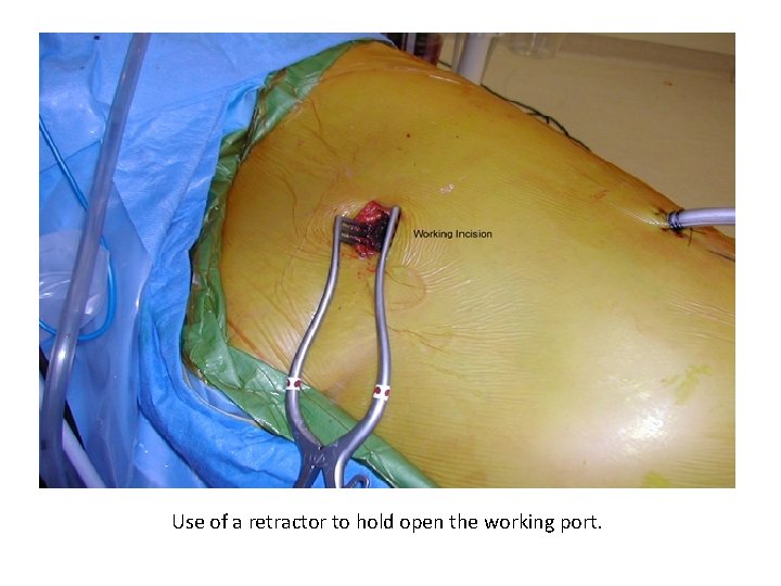 Use of a retractor to hold open the working port. 