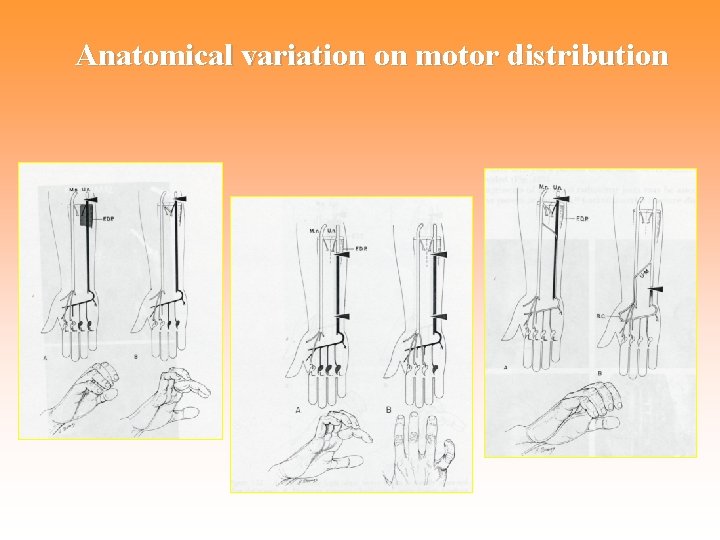 Anatomical variation on motor distribution 
