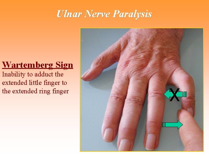 Ulnar Nerve Paralysis Wartemberg Sign Inability to adduct the extended little finger to the