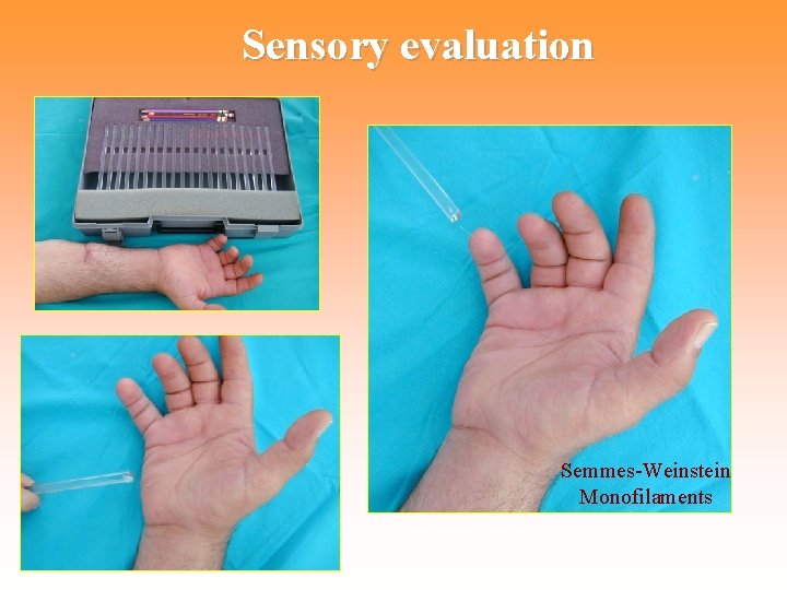 Sensory evaluation Semmes-Weinstein Monofilaments 