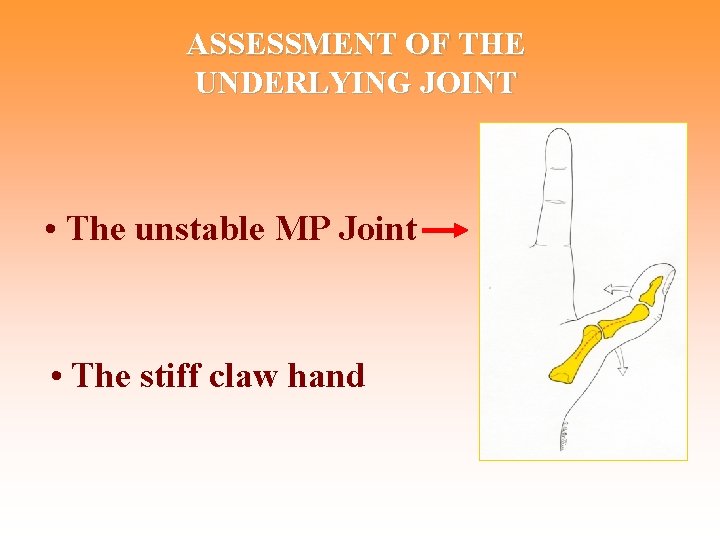 ASSESSMENT OF THE UNDERLYING JOINT • The unstable MP Joint • The stiff claw