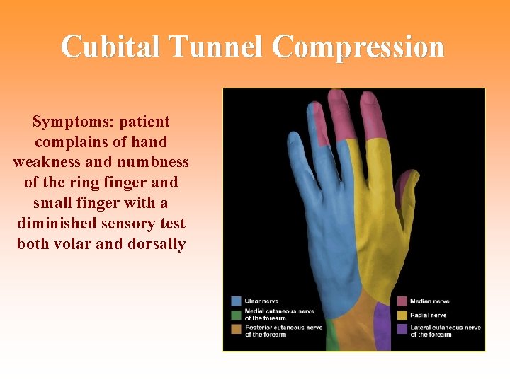 Cubital Tunnel Compression Symptoms: patient complains of hand weakness and numbness of the ring