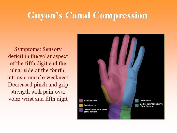 Guyon’s Canal Compression Symptoms: Sensory deficit in the volar aspect of the fifth digit