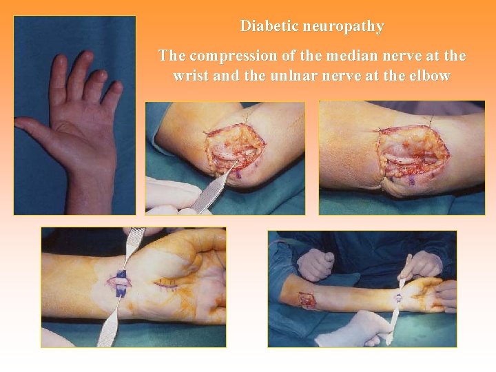 Diabetic neuropathy The compression of the median nerve at the wrist and the unlnar