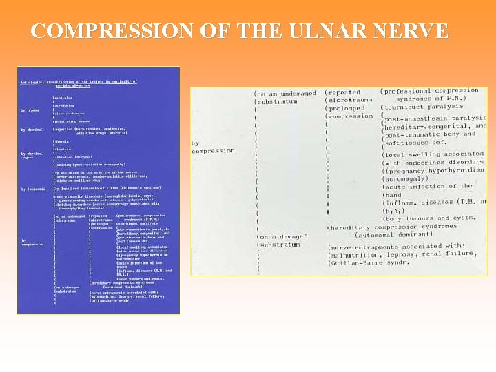 COMPRESSION OF THE ULNAR NERVE 