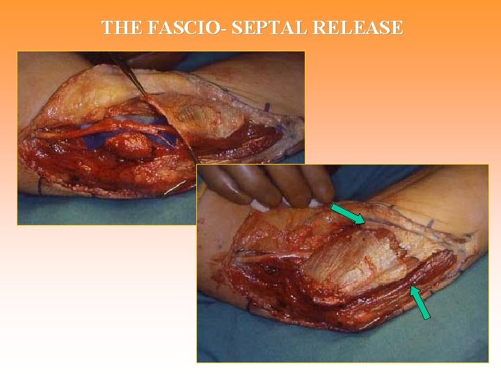 THE FASCIO- SEPTAL RELEASE 