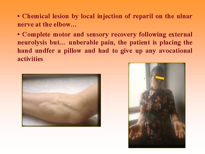  • Chemical lesion by local injection of reparil on the ulnar nerve at