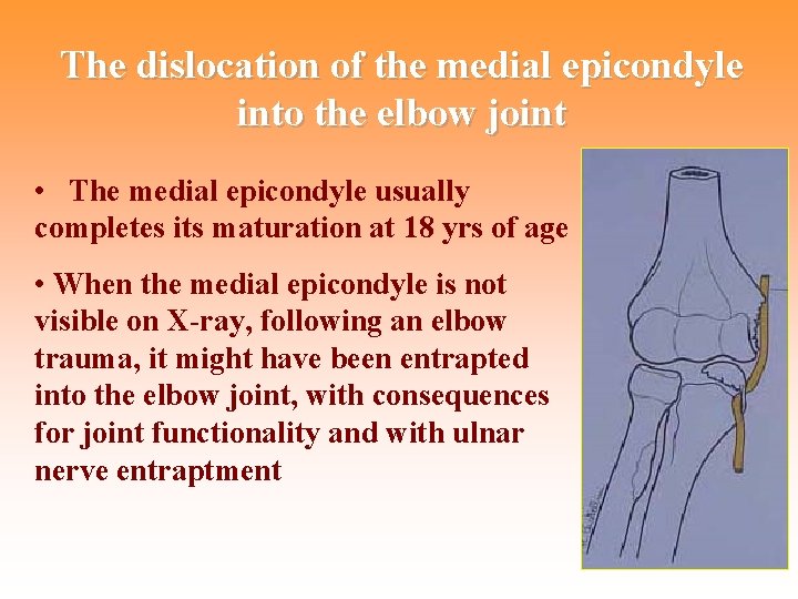 The dislocation of the medial epicondyle into the elbow joint • The medial epicondyle