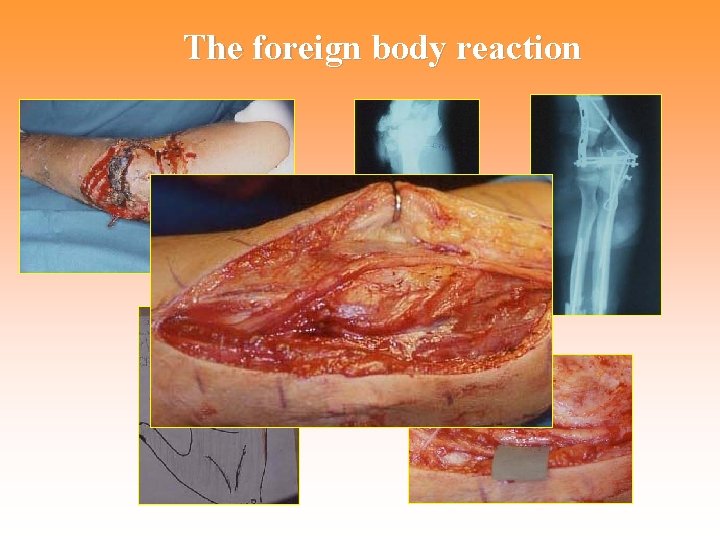 The foreign body reaction 