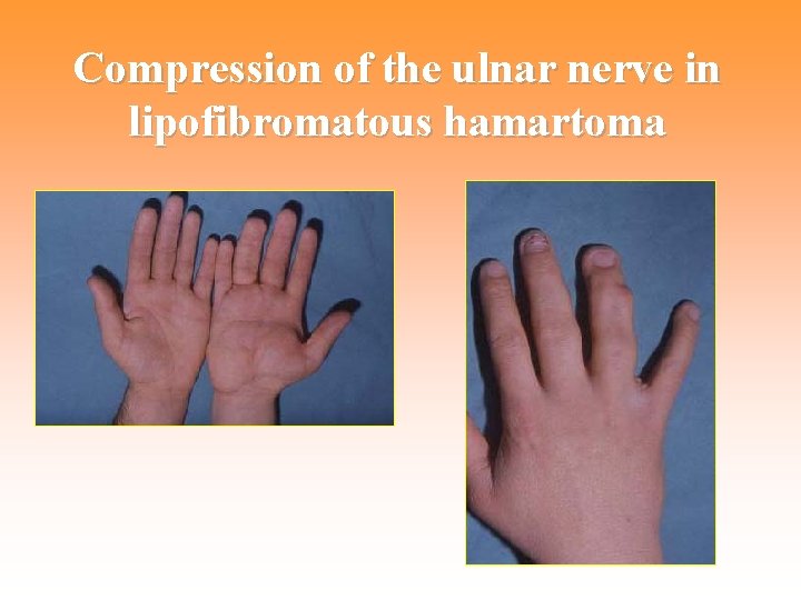 Compression of the ulnar nerve in lipofibromatous hamartoma 