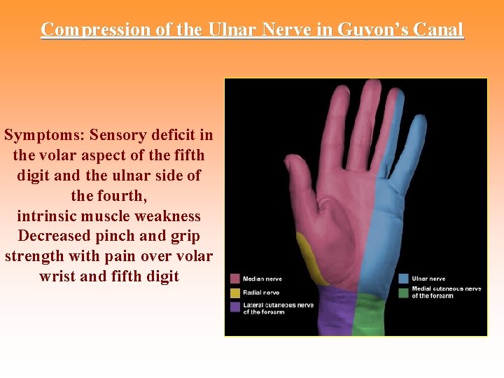 Compression of the Ulnar Nerve in Guyon’s Canal Symptoms: Sensory deficit in the volar