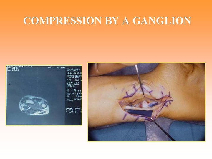 COMPRESSION BY A GANGLION 