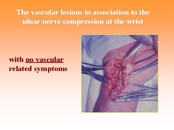 The vascular lesions in association to the ulnar nerve compression at the wrist with