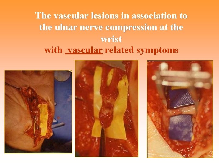 The vascular lesions in association to the ulnar nerve compression at the wrist with