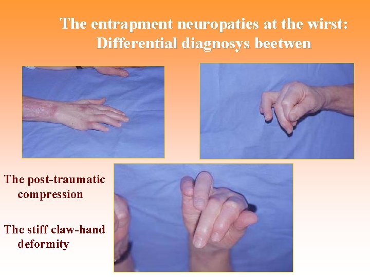 The entrapment neuropaties at the wirst: Differential diagnosys beetwen The post-traumatic compression The stiff