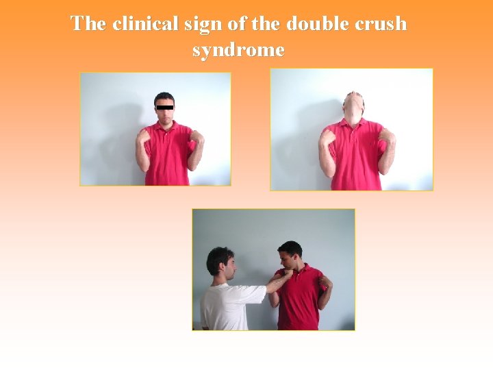 The clinical sign of the double crush syndrome 