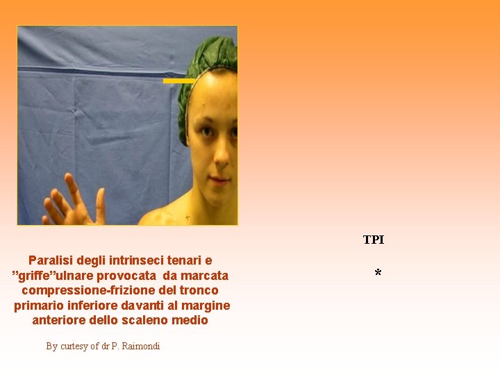 TPI Paralisi degli intrinseci tenari e ”griffe”ulnare provocata da marcata compressione-frizione del tronco primario