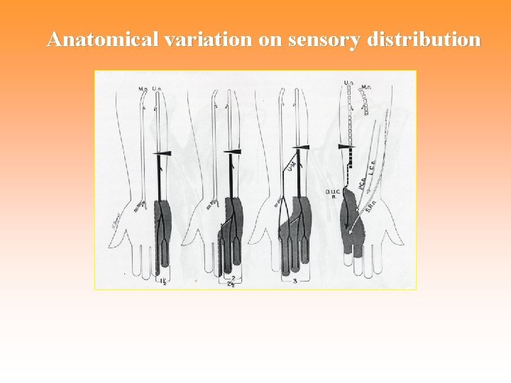 Anatomical variation on sensory distribution 