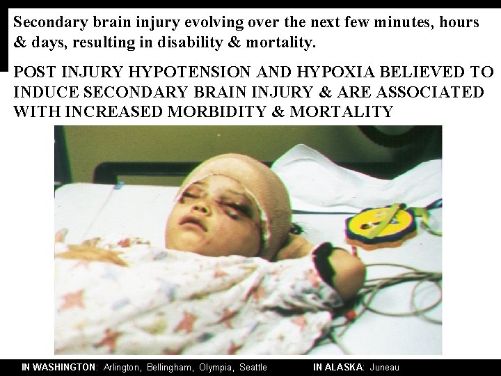 Secondary brain injury evolving over the next few minutes, hours & days, resulting in