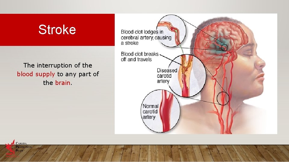Stroke The interruption of the blood supply to any part of the brain. 