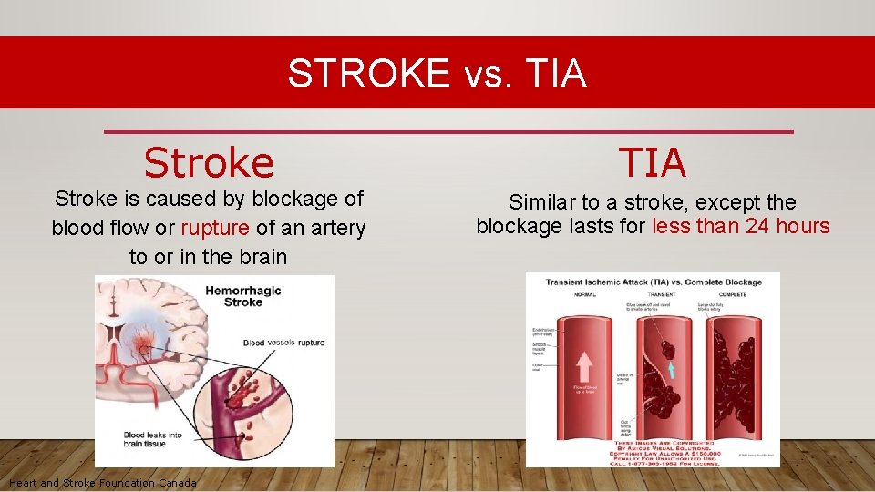 STROKE vs. TIA Stroke is caused by blockage of blood flow or rupture of