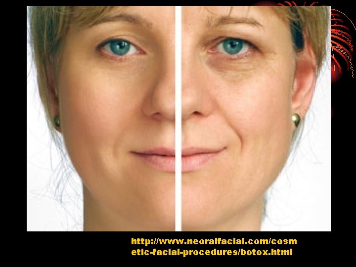 http: //www. neoralfacial. com/cosm etic-facial-procedures/botox. html 