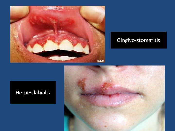 Gingivo-stomatitis Herpes labialis 