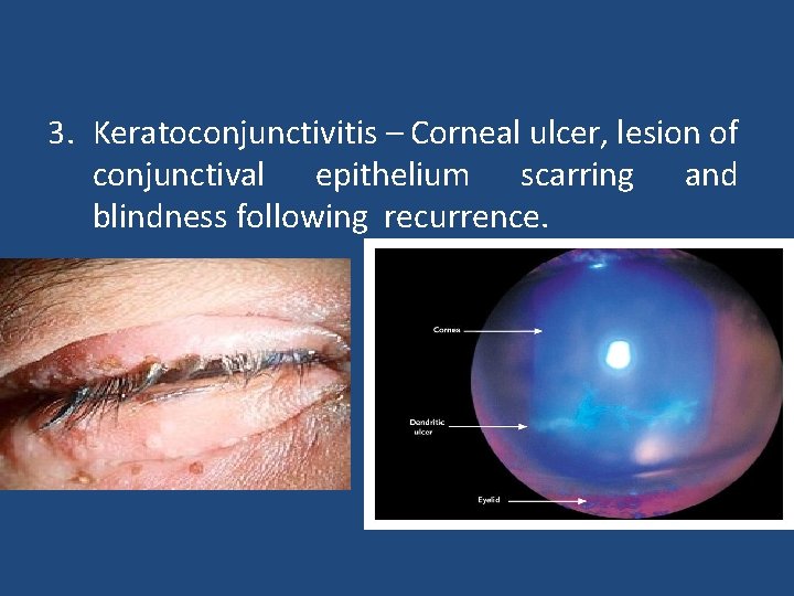 3. Keratoconjunctivitis – Corneal ulcer, lesion of conjunctival epithelium scarring and blindness following recurrence.