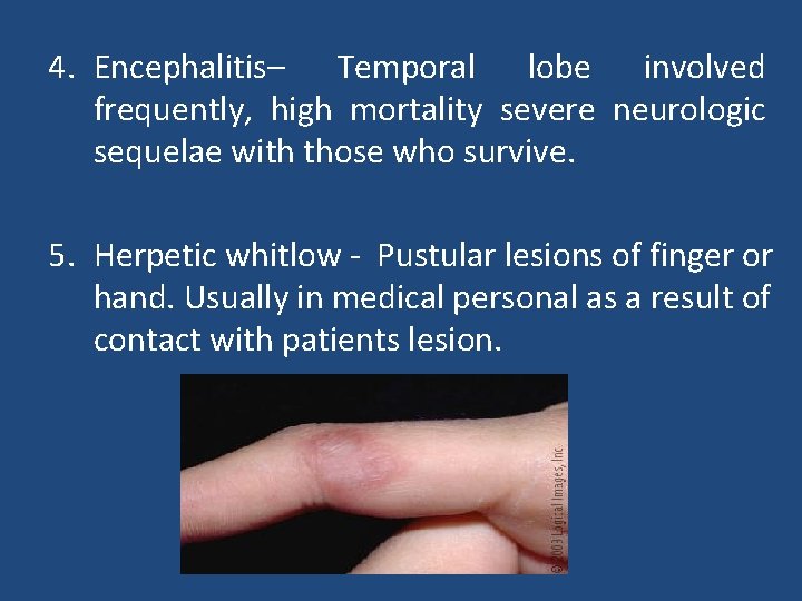 4. Encephalitis– Temporal lobe involved frequently, high mortality severe neurologic sequelae with those who