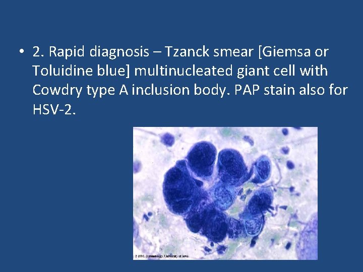  • 2. Rapid diagnosis – Tzanck smear [Giemsa or Toluidine blue] multinucleated giant