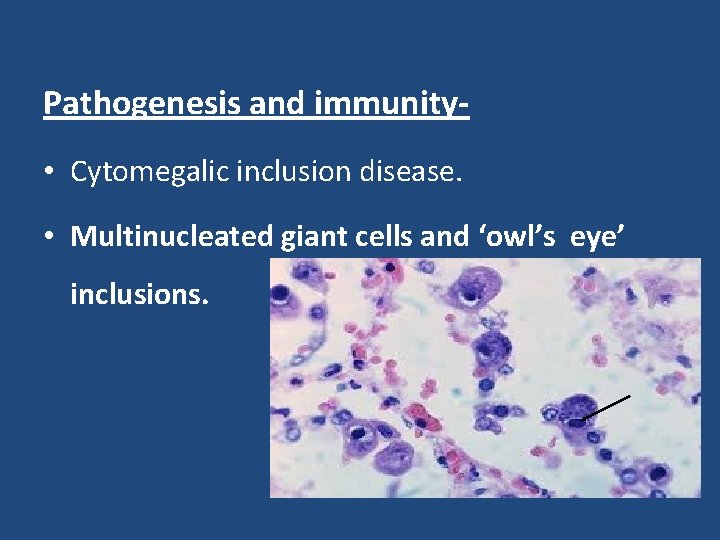 Pathogenesis and immunity • Cytomegalic inclusion disease. • Multinucleated giant cells and ‘owl’s eye’