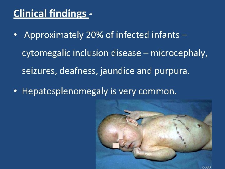 Clinical findings • Approximately 20% of infected infants – cytomegalic inclusion disease – microcephaly,