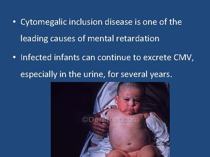  • Cytomegalic inclusion disease is one of the leading causes of mental retardation