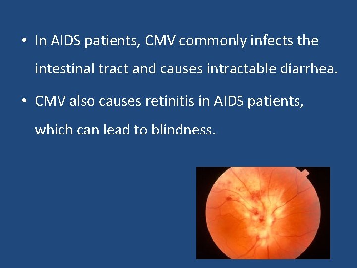  • In AIDS patients, CMV commonly infects the intestinal tract and causes intractable