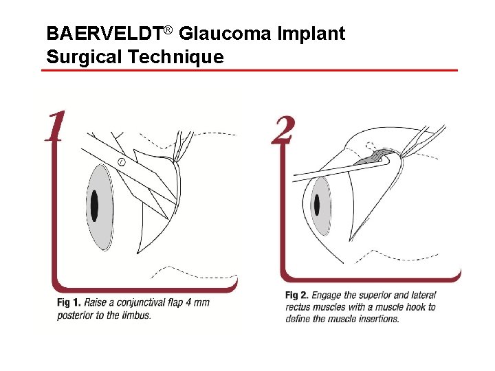 BAERVELDT® Glaucoma Implant Surgical Technique 
