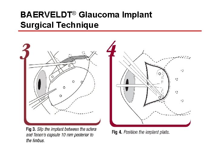 BAERVELDT® Glaucoma Implant Surgical Technique 