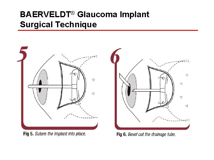 BAERVELDT® Glaucoma Implant Surgical Technique 