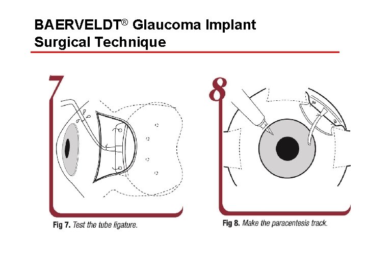 BAERVELDT® Glaucoma Implant Surgical Technique 