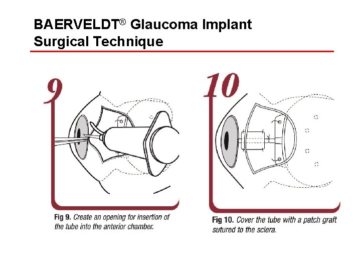 BAERVELDT® Glaucoma Implant Surgical Technique 