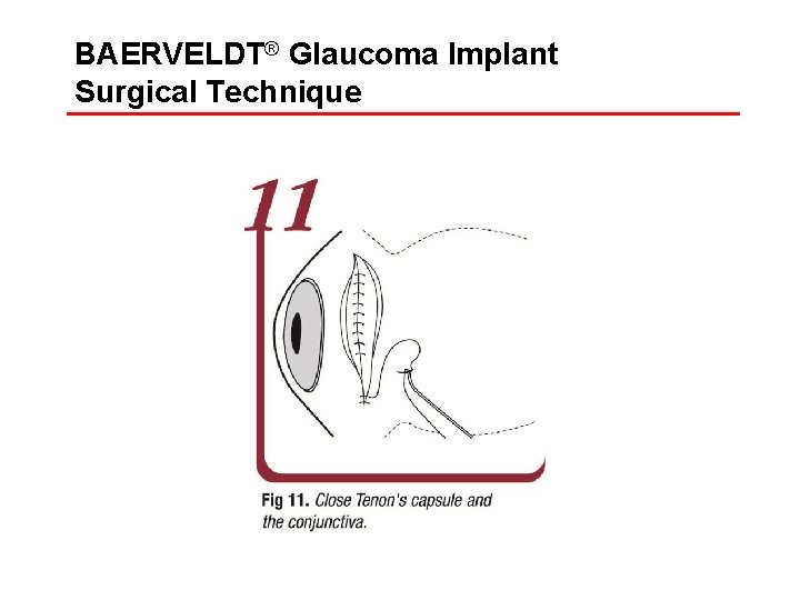 BAERVELDT® Glaucoma Implant Surgical Technique 