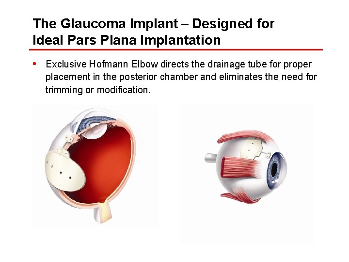 The Glaucoma Implant – Designed for Ideal Pars Plana Implantation • Exclusive Hofmann Elbow