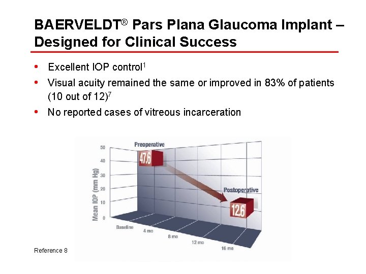 BAERVELDT® Pars Plana Glaucoma Implant – Designed for Clinical Success • Excellent IOP control