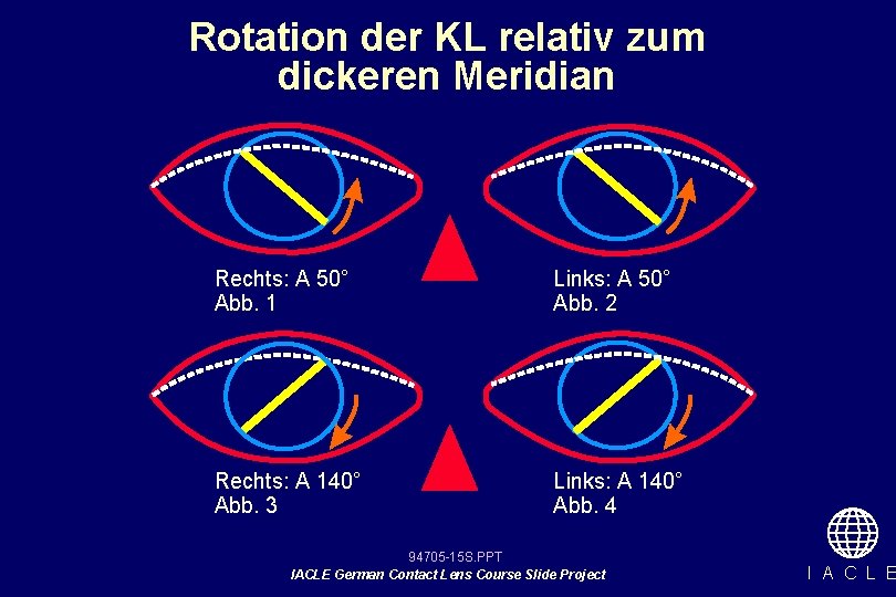 Rotation der KL relativ zum dickeren Meridian Rechts: A 50° Abb. 1 Links: A