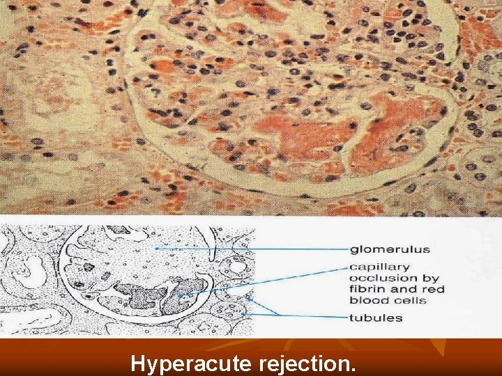Hyperacute rejection. Hyperacute rejection.