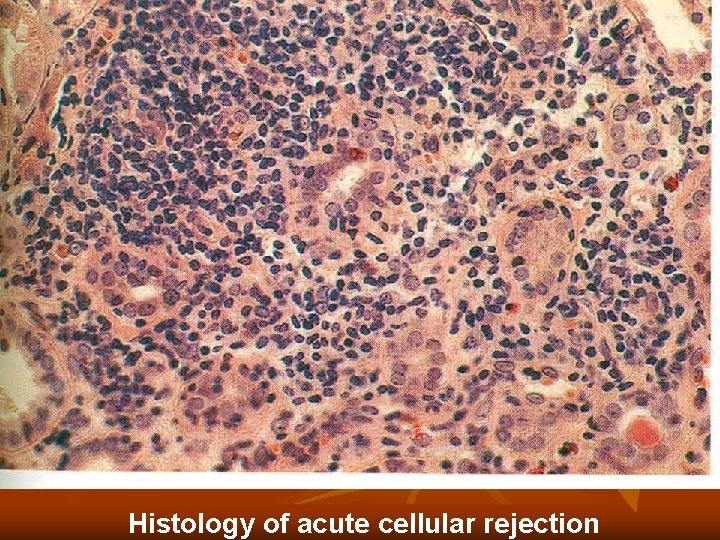 Histology of acute cellular rejection Histology of acute cellular rejection