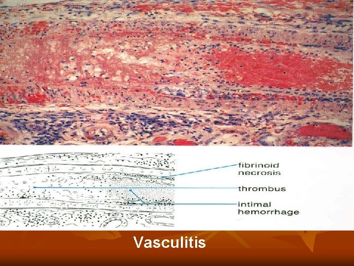 Vasculitis Vasculitis